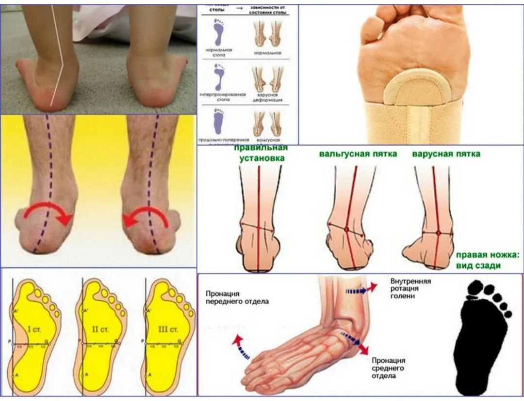 Плоскостопие вальгусная стопа у ребенка